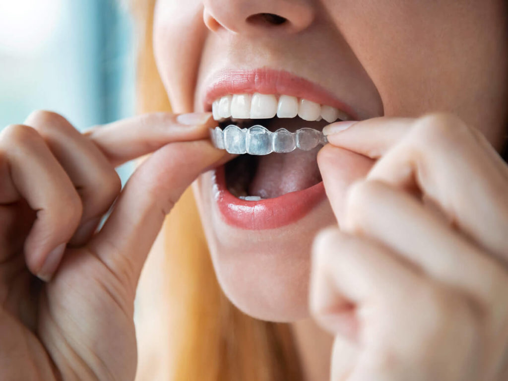 woman putting invisalign aligners in mouth